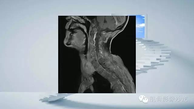 【病例】恶性外周神经鞘瘤2例MR影像表现