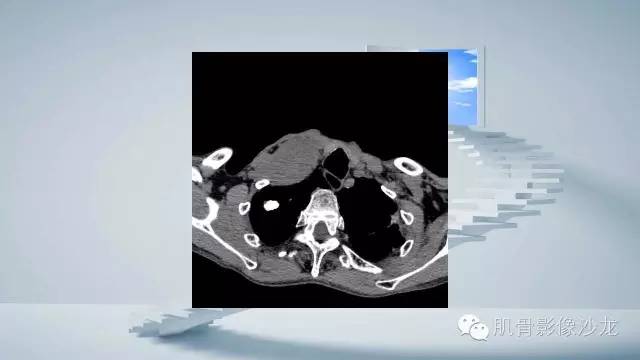 【病例】恶性外周神经鞘瘤2例MR影像表现