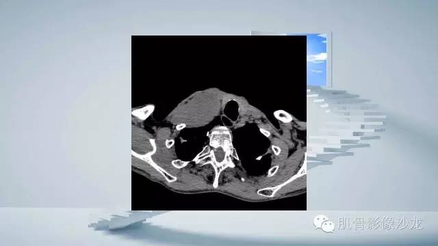 【病例】恶性外周神经鞘瘤2例MR影像表现