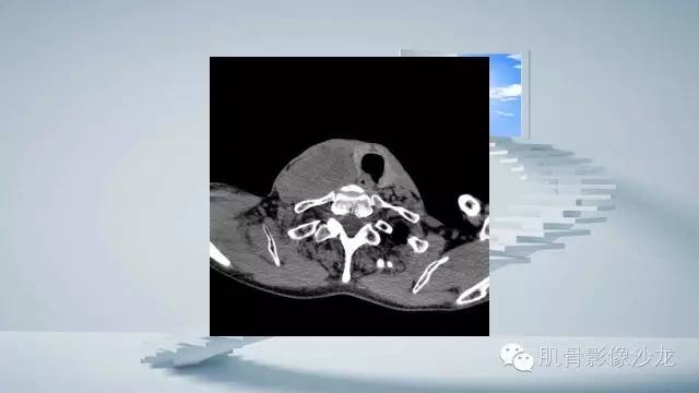 【病例】恶性外周神经鞘瘤2例MR影像表现