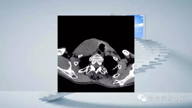 【病例】恶性外周神经鞘瘤2例MR影像表现