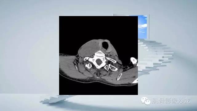 【病例】恶性外周神经鞘瘤2例MR影像表现