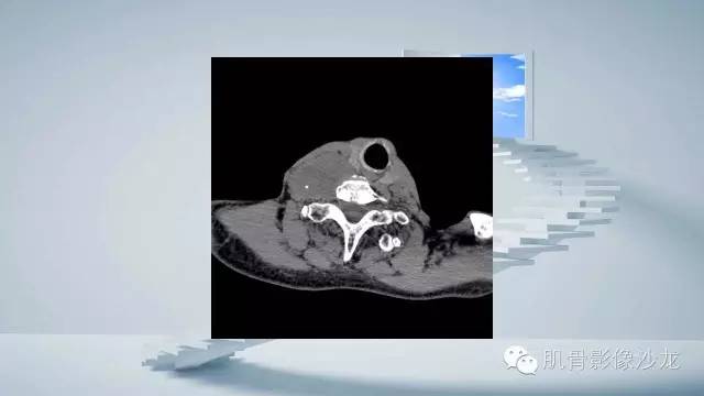【病例】恶性外周神经鞘瘤2例MR影像表现