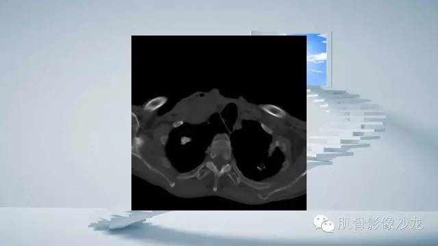 【病例】恶性外周神经鞘瘤2例MR影像表现