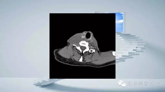 【病例】恶性外周神经鞘瘤2例MR影像表现