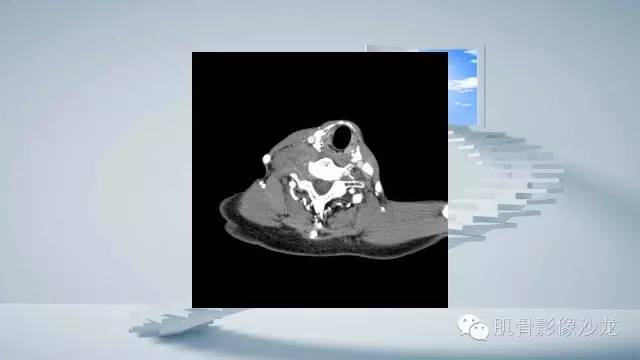 【病例】恶性外周神经鞘瘤2例MR影像表现