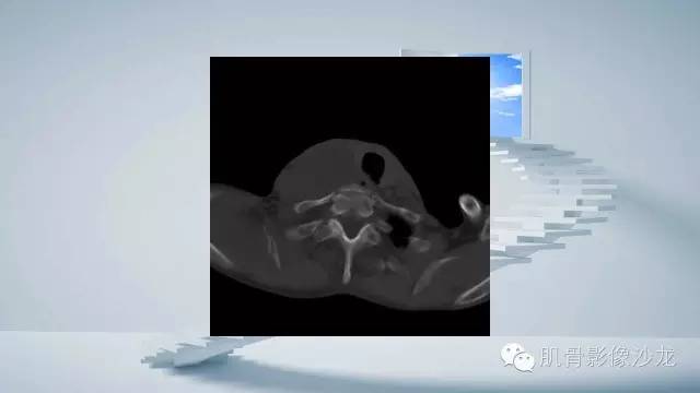 【病例】恶性外周神经鞘瘤2例MR影像表现