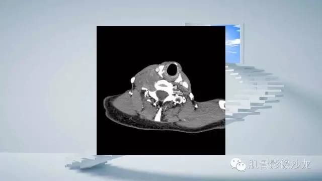 【病例】恶性外周神经鞘瘤2例MR影像表现