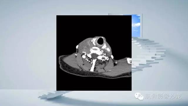 【病例】恶性外周神经鞘瘤2例MR影像表现