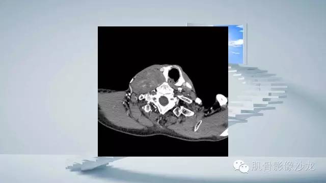 【病例】恶性外周神经鞘瘤2例MR影像表现