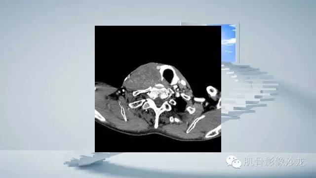 【病例】恶性外周神经鞘瘤2例MR影像表现