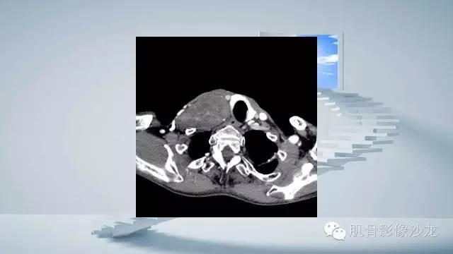 【病例】恶性外周神经鞘瘤2例MR影像表现