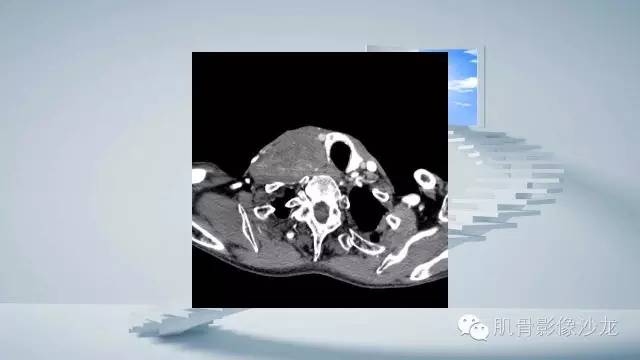 【病例】恶性外周神经鞘瘤2例MR影像表现