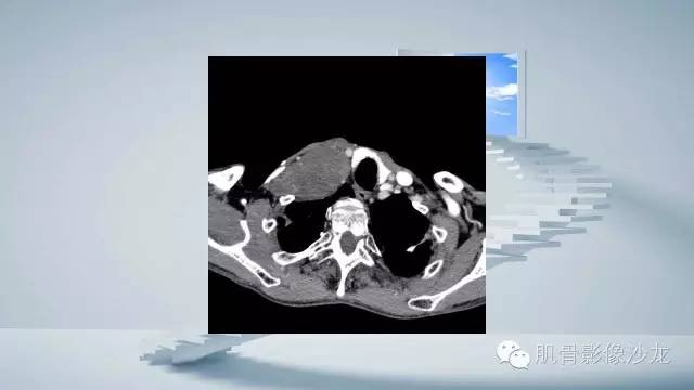 【病例】恶性外周神经鞘瘤2例MR影像表现