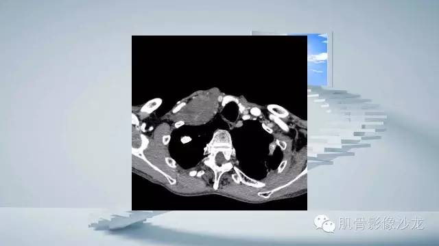 【病例】恶性外周神经鞘瘤2例MR影像表现