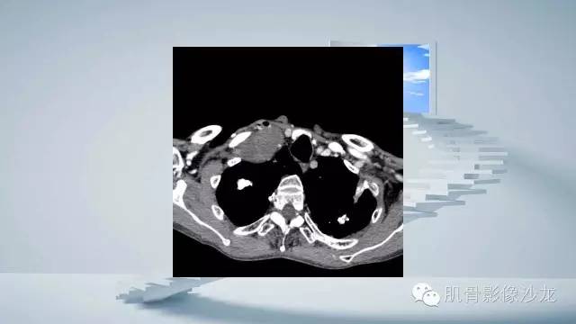 【病例】恶性外周神经鞘瘤2例MR影像表现