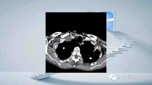 【病例】恶性外周神经鞘瘤2例MR影像表现