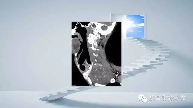 【病例】恶性外周神经鞘瘤2例MR影像表现