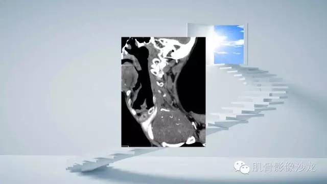 【病例】恶性外周神经鞘瘤2例MR影像表现