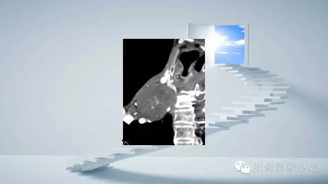 【病例】恶性外周神经鞘瘤2例MR影像表现