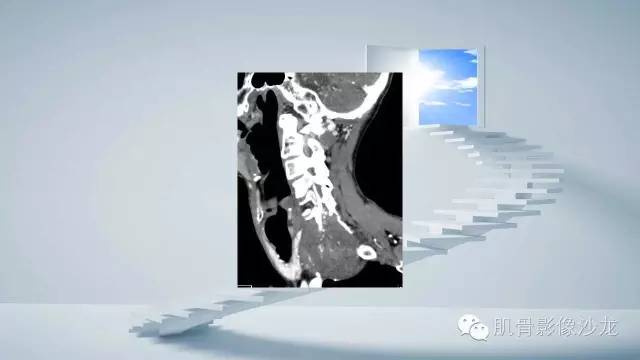 【病例】恶性外周神经鞘瘤2例MR影像表现
