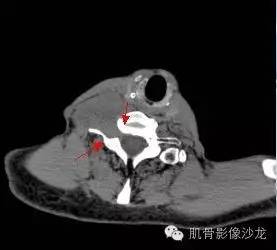 【病例】恶性外周神经鞘瘤2例MR影像表现