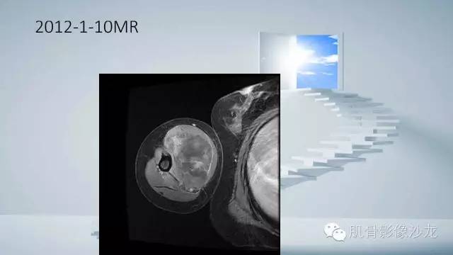 【病例】恶性外周神经鞘瘤2例MR影像表现