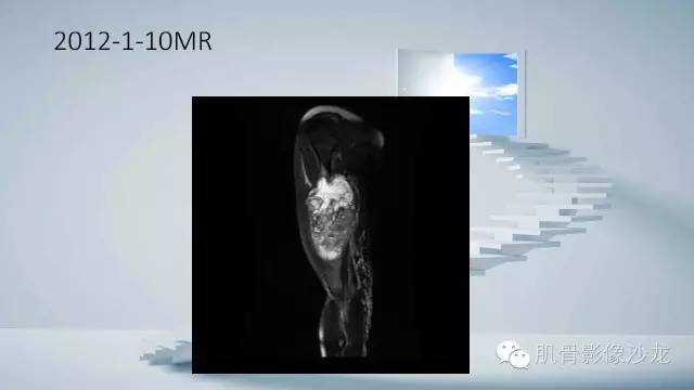 【病例】恶性外周神经鞘瘤2例MR影像表现