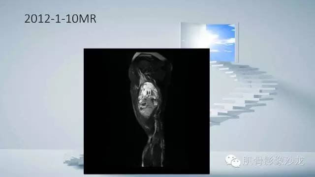 【病例】恶性外周神经鞘瘤2例MR影像表现