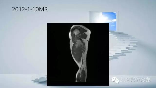 【病例】恶性外周神经鞘瘤2例MR影像表现