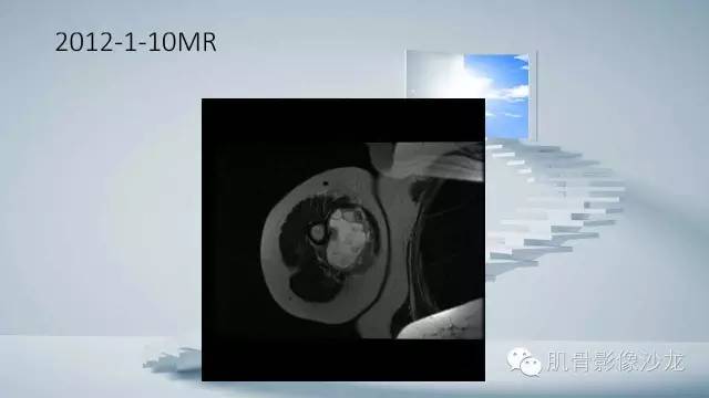 【病例】恶性外周神经鞘瘤2例MR影像表现