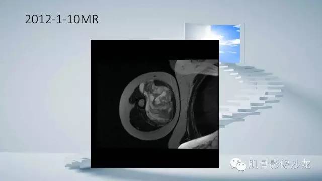 【病例】恶性外周神经鞘瘤2例MR影像表现