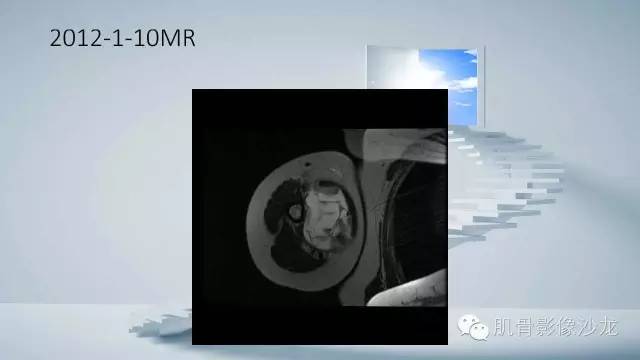 【病例】恶性外周神经鞘瘤2例MR影像表现