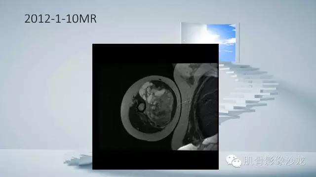 【病例】恶性外周神经鞘瘤2例MR影像表现