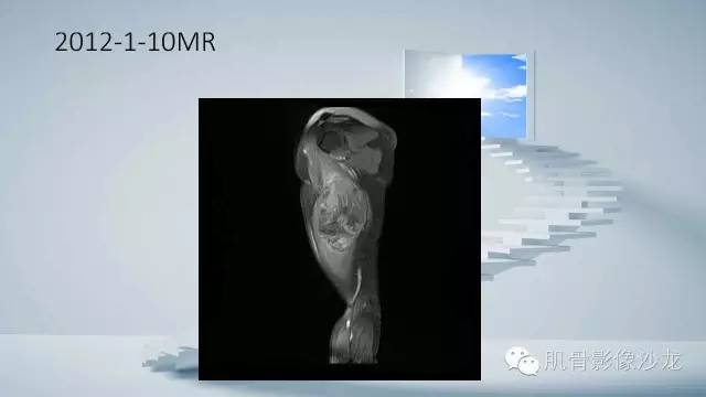 【病例】恶性外周神经鞘瘤2例MR影像表现