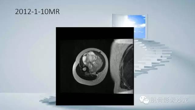 【病例】恶性外周神经鞘瘤2例MR影像表现