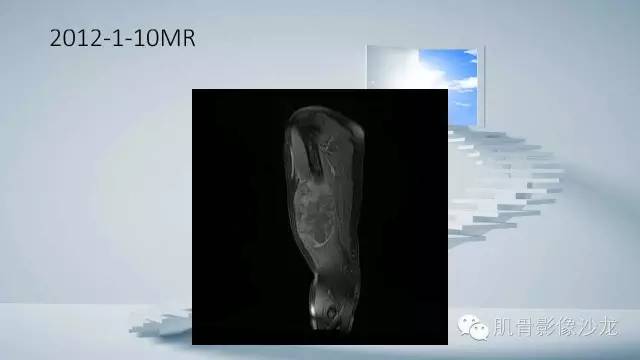 【病例】恶性外周神经鞘瘤2例MR影像表现