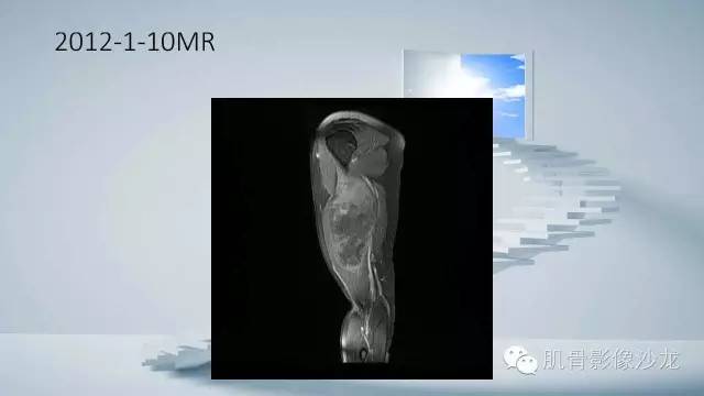 【病例】恶性外周神经鞘瘤2例MR影像表现