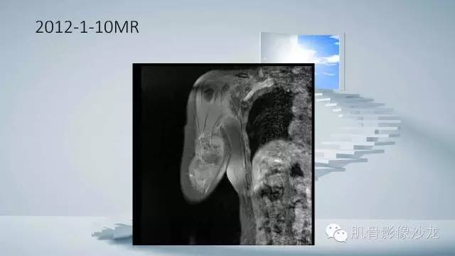 【病例】恶性外周神经鞘瘤2例MR影像表现