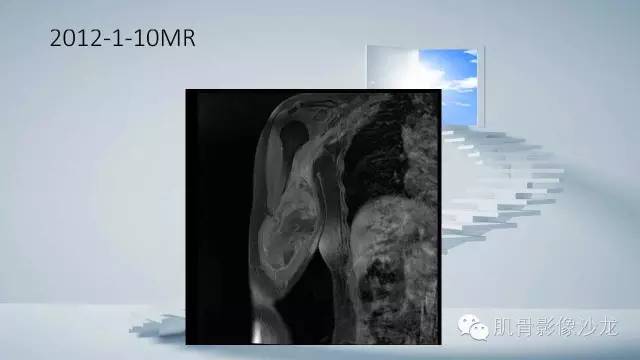 【病例】恶性外周神经鞘瘤2例MR影像表现