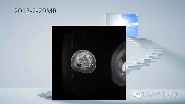 【病例】恶性外周神经鞘瘤2例MR影像表现