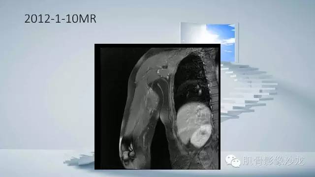 【病例】恶性外周神经鞘瘤2例MR影像表现