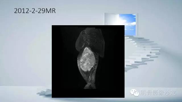【病例】恶性外周神经鞘瘤2例MR影像表现