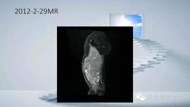 【病例】恶性外周神经鞘瘤2例MR影像表现