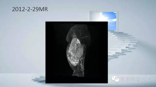 【病例】恶性外周神经鞘瘤2例MR影像表现