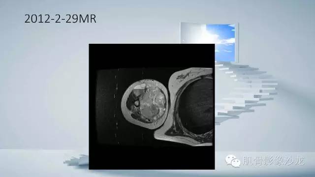 【病例】恶性外周神经鞘瘤2例MR影像表现