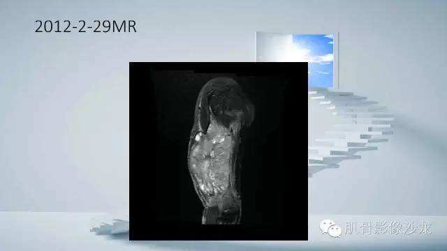 【病例】恶性外周神经鞘瘤2例MR影像表现