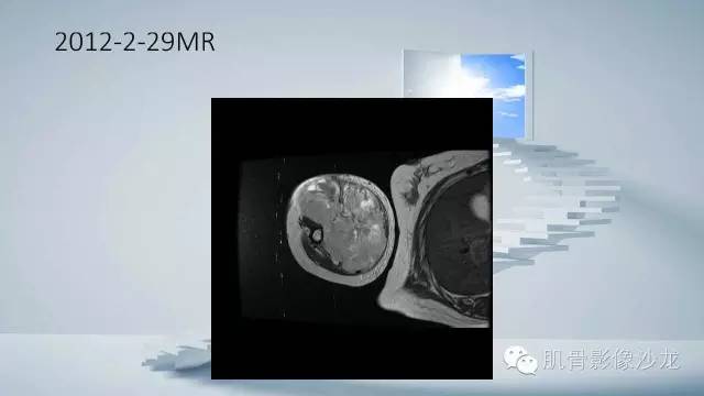 【病例】恶性外周神经鞘瘤2例MR影像表现