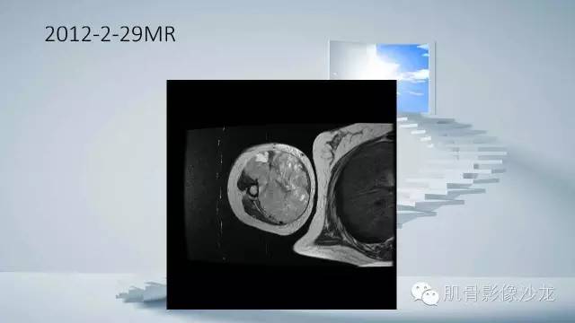 【病例】恶性外周神经鞘瘤2例MR影像表现