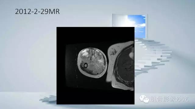 【病例】恶性外周神经鞘瘤2例MR影像表现